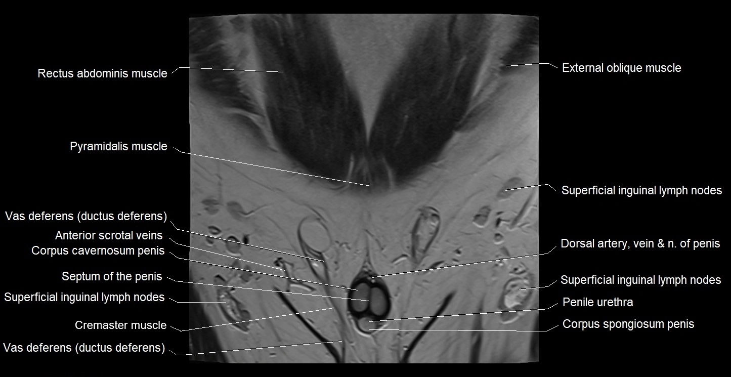MRI coronal cross sectional anatomy male pelvis image 2.webp